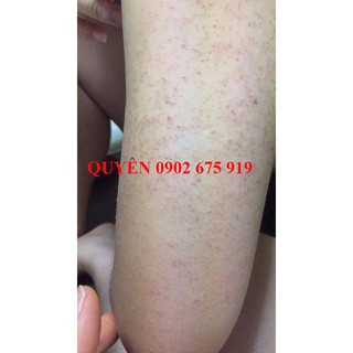 TẨY TẾ BÀO CHẾT - VIEM NANG LONG