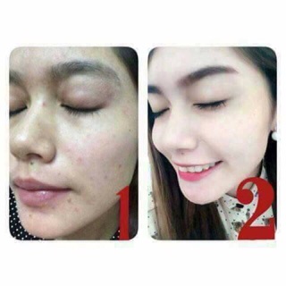Kem hỗ trợ mụn thâm BioAqua 30ml