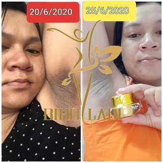 SIÊU DƯỠNG THÂM 5S BIHO LADI