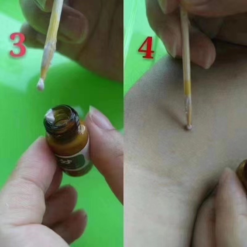 Kem tẩy nốt ruồi chấm nám tàn  nhang