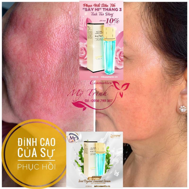 TINH TẢO BĂNG DERMAPEEL - ICED CRYSTAL SEAWEED SERUM - GIẢM TÌNH TRẠNG DA SƯNG ĐỎ NHANH CHÓNG - HÀN QUỐC