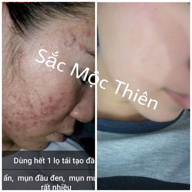 Tái tạo da cao cấp Sắc Mộc Thiên- Hỗ trợ cải thiện mụn- Nám- Tàn nhang- Sẹo | BigBuy360 - bigbuy360.vn