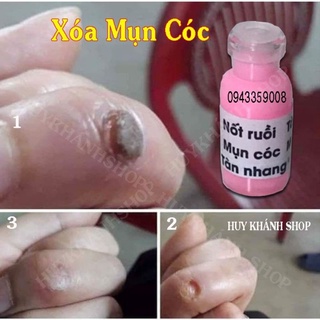 Tẩy Nốt Ruồi Mụn,Mụt Cóc,Tàn Nhang Mụn Thịt,Mắc Cá