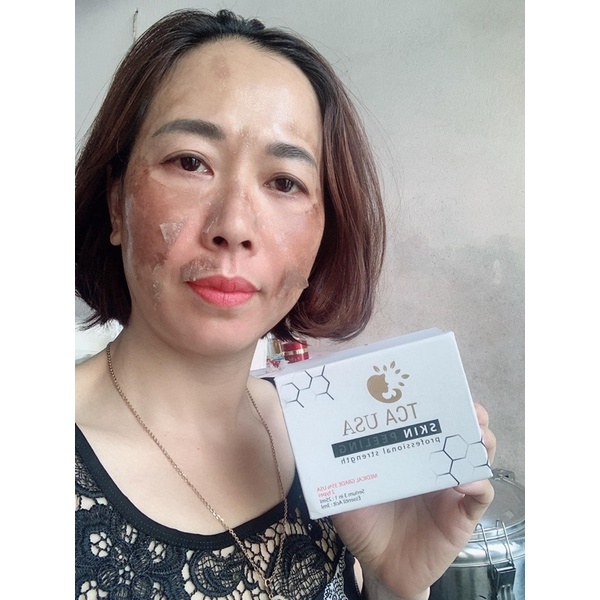 PEEL TCA TRIỆT THÂM NÁCH