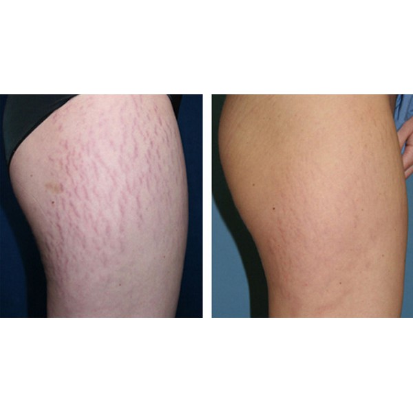 Viên uống căng da Babolica – Ngăn ngừa da chảy xệ, lão hóa da (Hộp 30 viên)