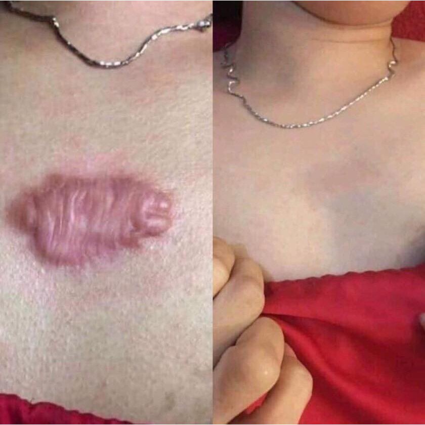 🔥Hàng có sẵn 🔥thành phần tự nhiên kem loại bỏ sẹo phục hồi da gel loại bỏ sẹo và rạn da