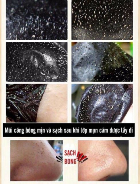 Gel hút mụn đầu đen - gel lột mụn than tre hoạt tính | BigBuy360 - bigbuy360.vn