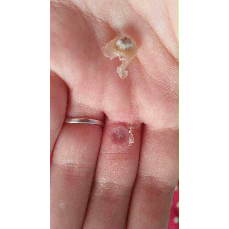 [Mã SKAMLTSM11 giảm 10% đơn 99K] Gel Tẩy Mụn Thịt, Mụn Cóc, Nốt Ruồi Nga - Cynep | BigBuy360 - bigbuy360.vn