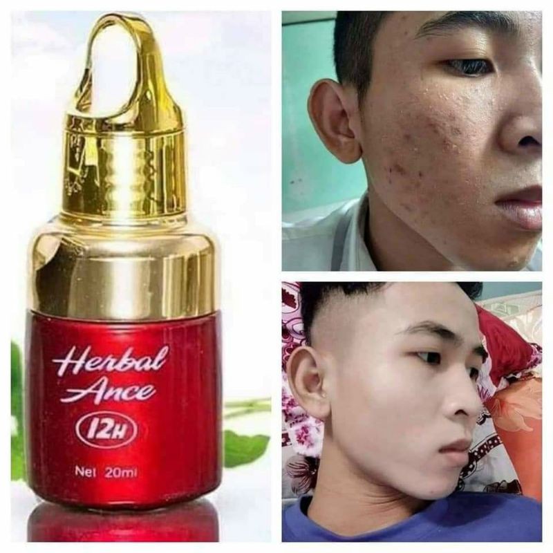 serum chấm mụn HĐ