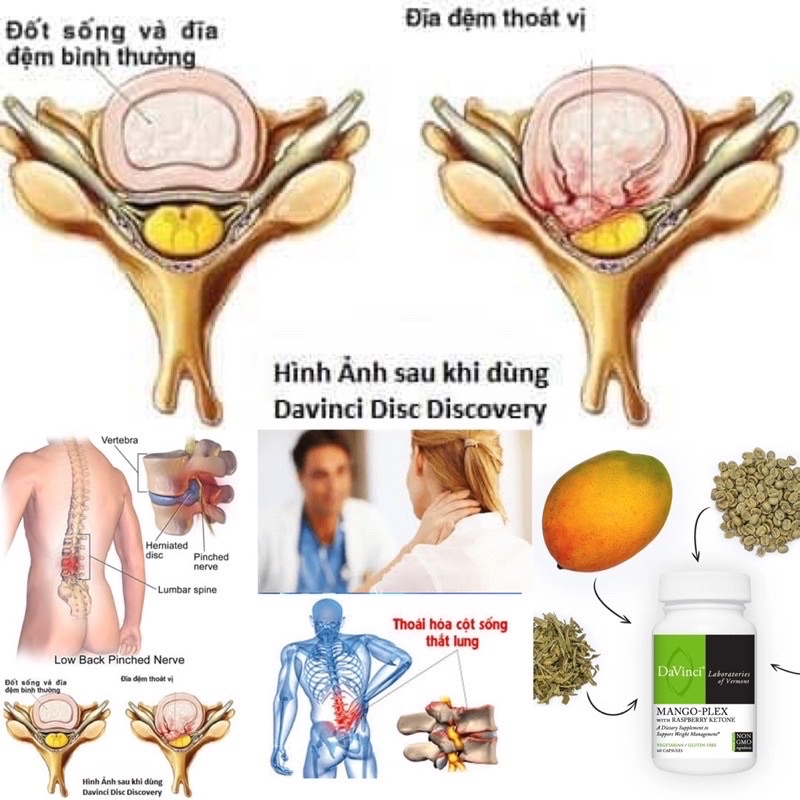 Viên Uống Disc Discovery Davinci 180 Viên Hỗ Trợ Thoát Vị Đĩa Đệm Thoái Hóa Cột Sống