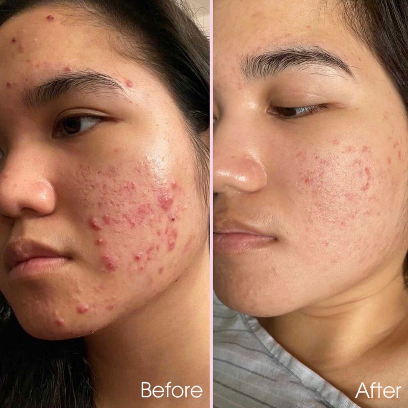 Chấm Mụn I'm From Mugwort Spot Gel