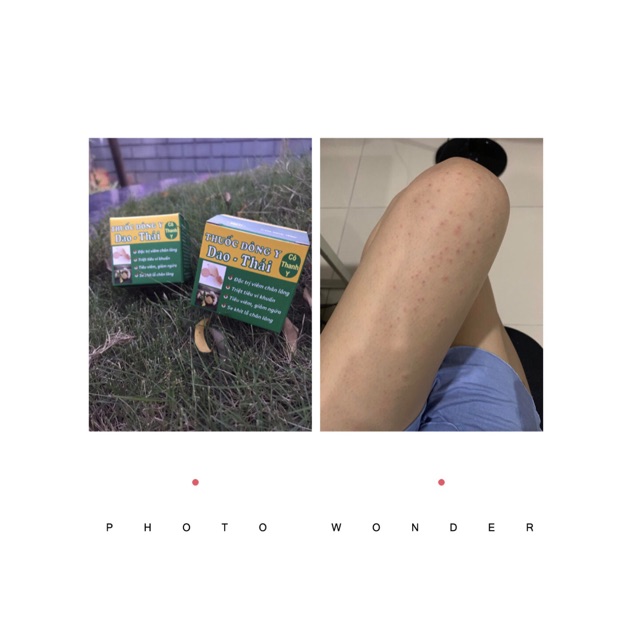 01 kem bôi #viêm nang lông