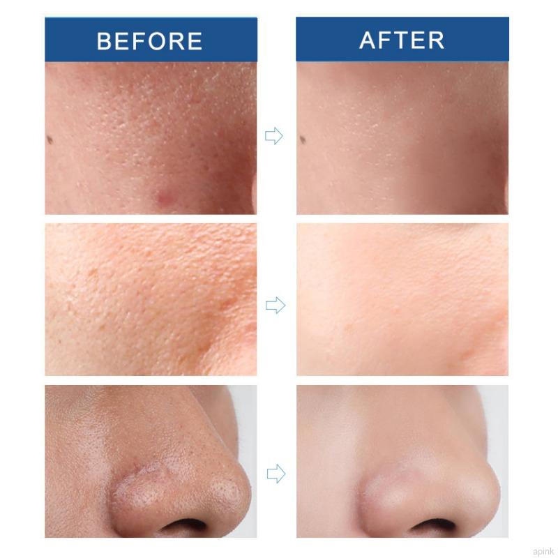 Serum loại bỏ mụn đầu đen thu nhỏ lỗ chân lông dưỡng ẩm da