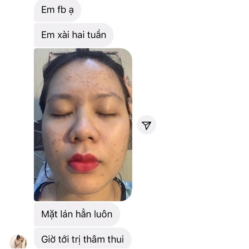 TURMERIC EXTRACT -ĐÁNH BAY MỤN ẨN VÀ CÁC LOẠI MỤN | BigBuy360 - bigbuy360.vn