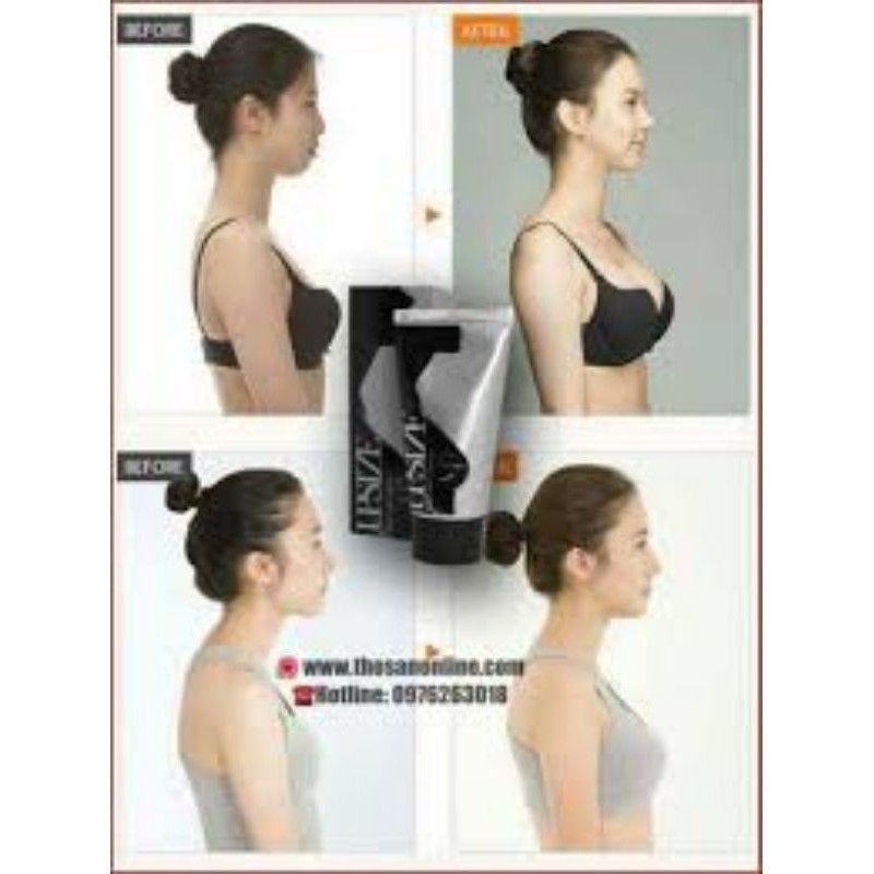 KEM NỞ NGỰC UPSIZE NGA.