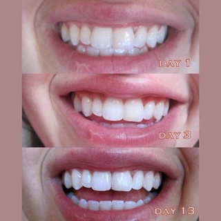 [Date 7/2022] Miếng Dán Trắng Răng Oral-B Úc