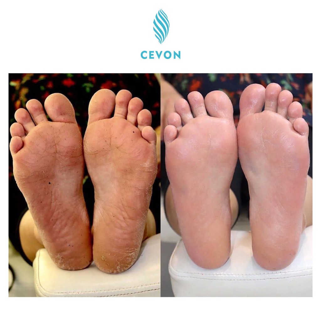 Hộp 1 đôi  2 miếng Ủ DA CHẾT CHÂN  FOOT PEEL, thương hiệu CEVON,  xuất xứ Korean