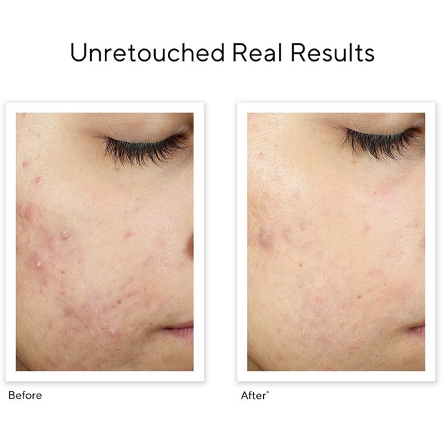 Serum Vô hình hóa sẹo &amp; thâm mụn Murad InvisiScar Resurfacing Treatment