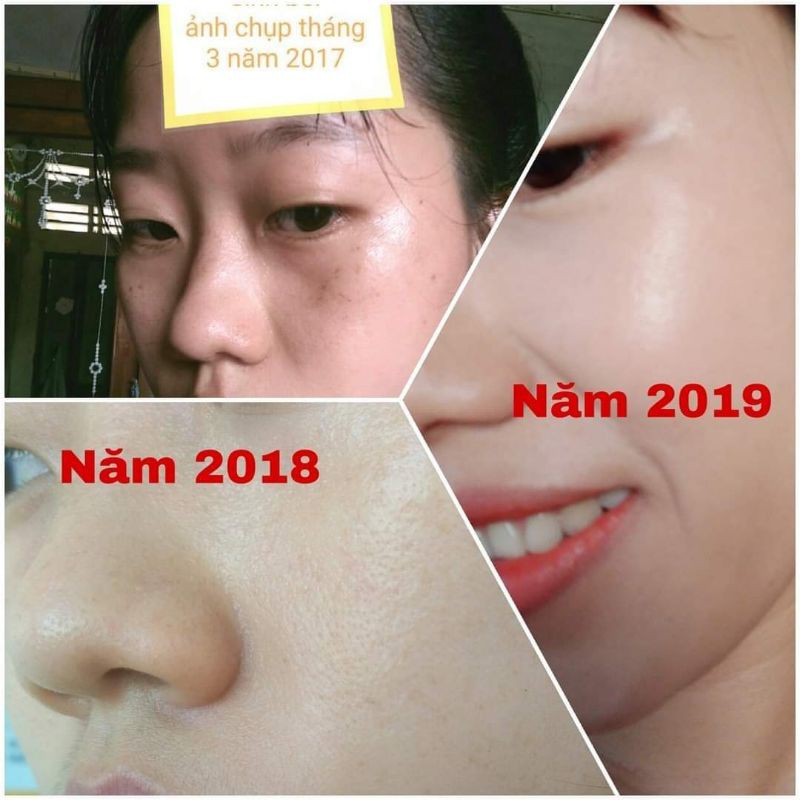 TINH CHẤT GIẢM NÁM, TÀN NHANG, NGỪA LÃO HÓA [CHÍNH HÃNG] | BigBuy360 - bigbuy360.vn