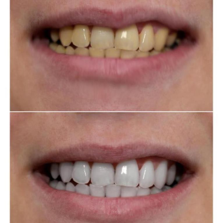 Smilee Extra, Smilee Max - Máy làm trắng răng không ê buốt, làm trắng 3-6 tone, xuất xứ USA