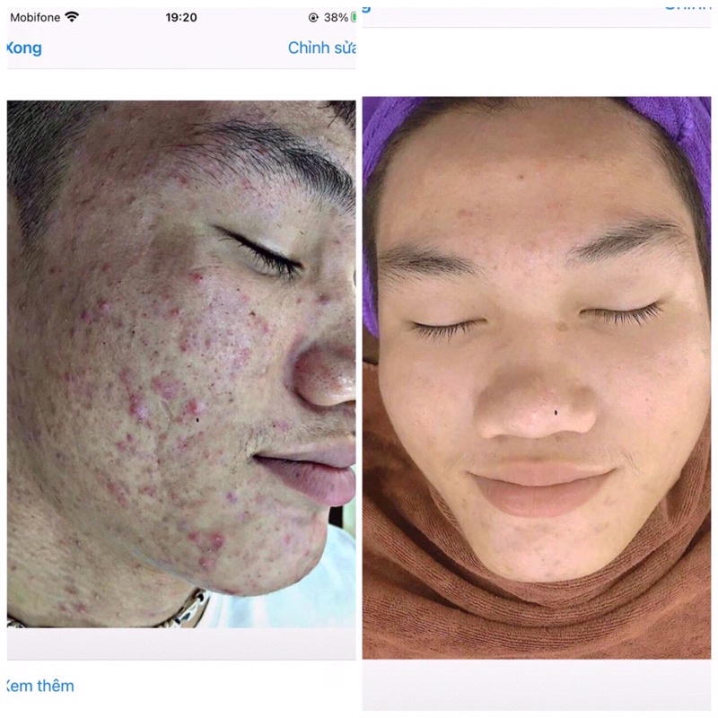 Bộ Đôi Serum Mụn DETOX-TREATMENT BRIGHT-KARMEL -Sạch Mụn,Sáng Da,Mờ Thâm Nám