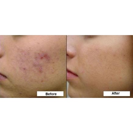 Noãn thực vật MH Beauty Spa - Thần dược MH xóa mụn