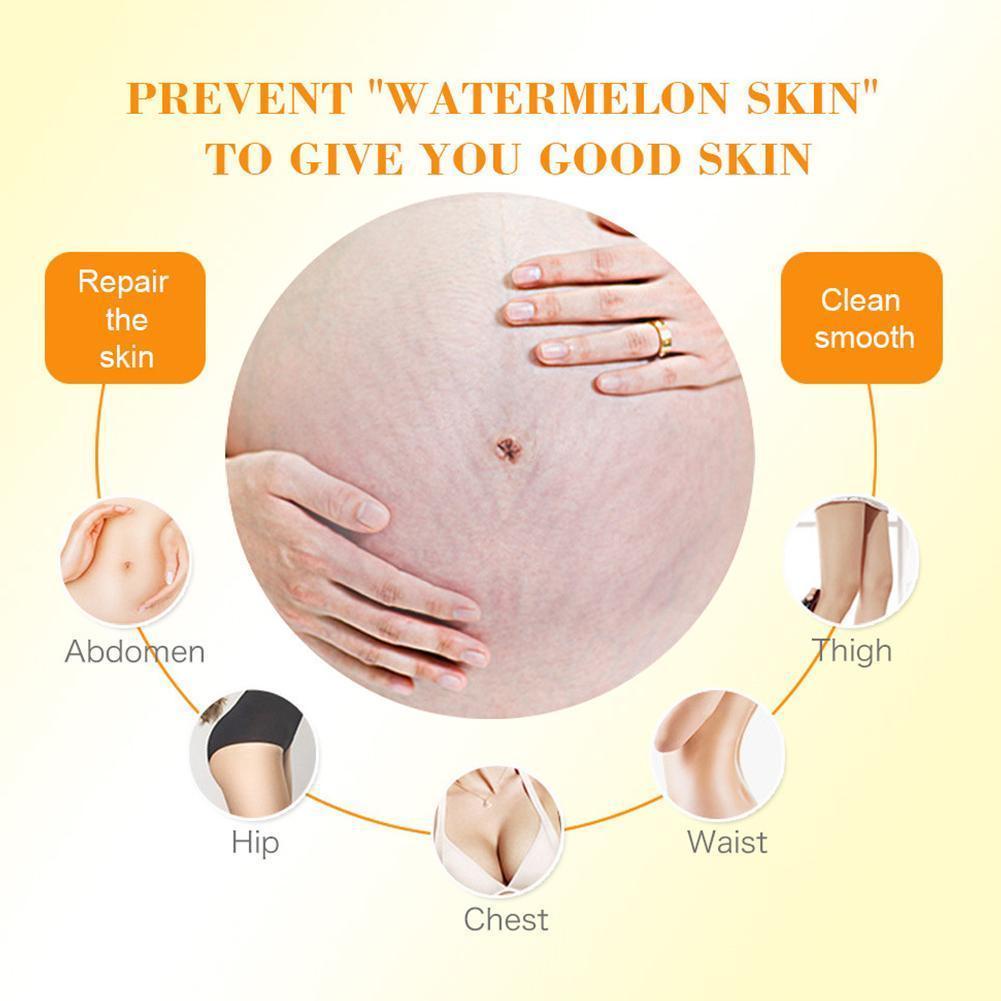 Kem Trị Rạn Da Sau Sinh Cho Phụ Nữ Mang Thai O8E2