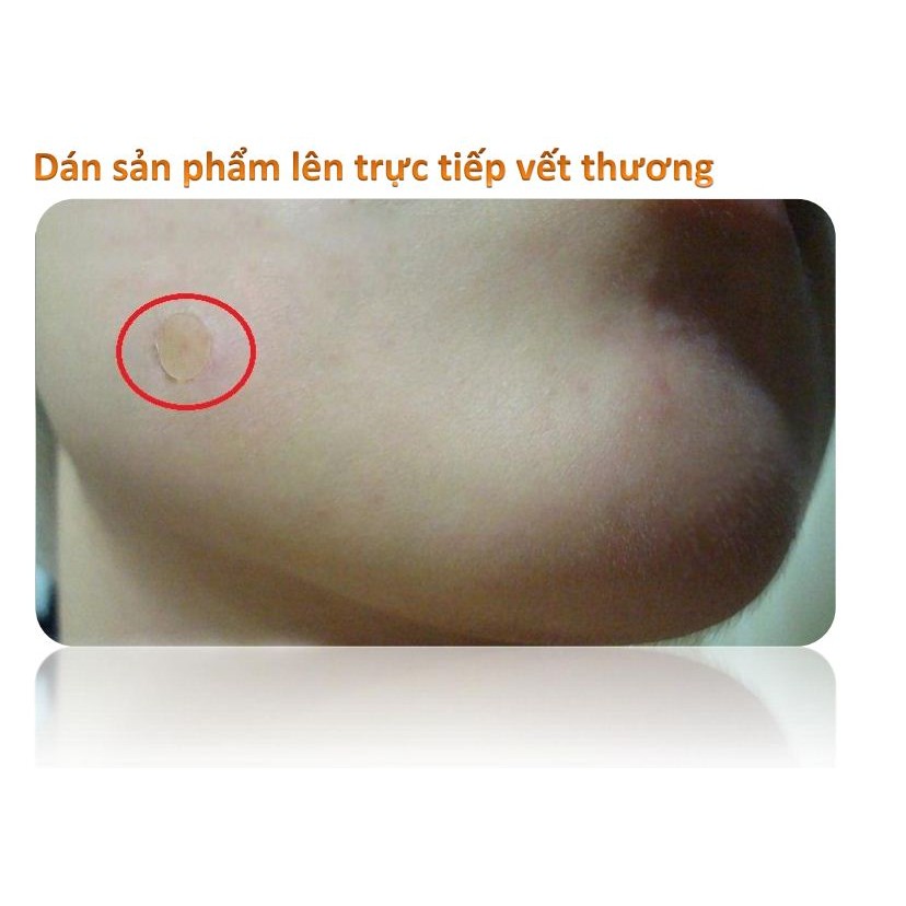 Miếng dán mụn hydrocolloid Somaderm Spot Pimple Patch 24 miếng 3 kích cỡ - MẪU MỚI HỘP XANH