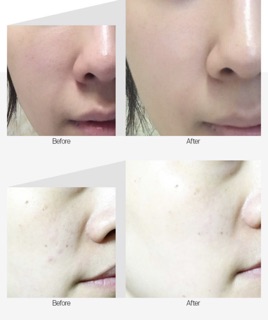 SERUM BORTOX MEDIPEEL HÀN QUỐC