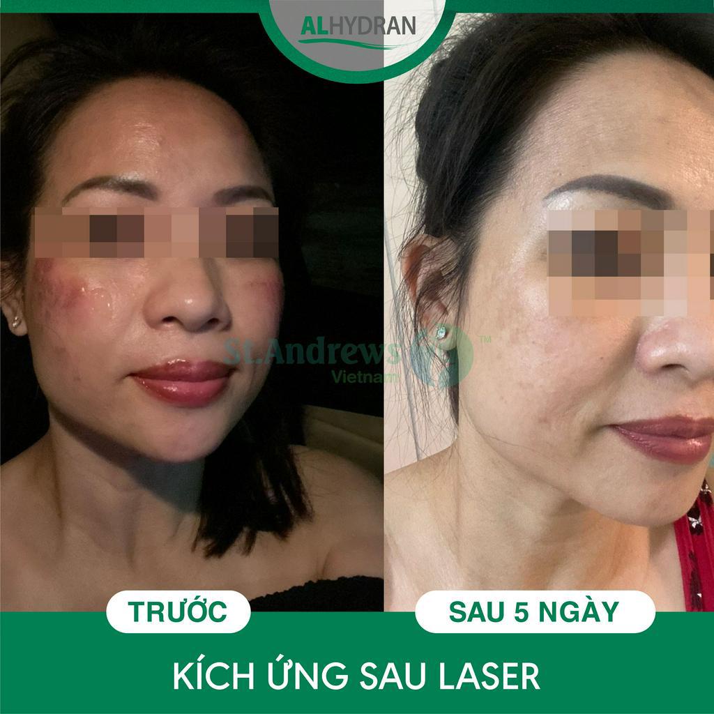 Kem dưỡng da sau phi kim Alhydran 15ml - hiệu quả đã được kiểm chứng bởi chuyên gia