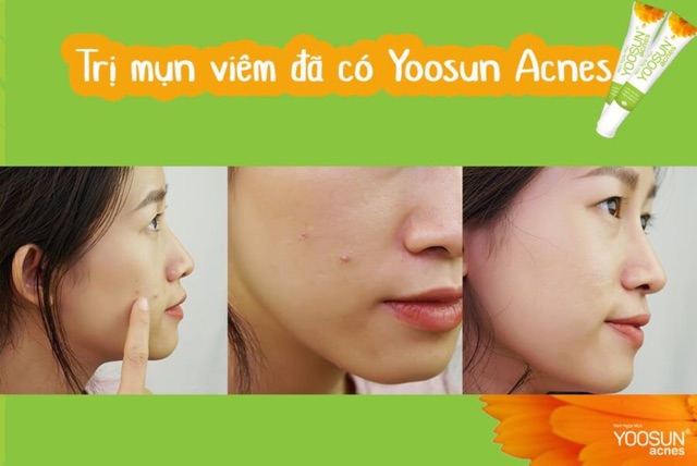 [CHÍNH HÃNG] Kem ngừa mụn và làm mờ sẹo Yoosun Acnes