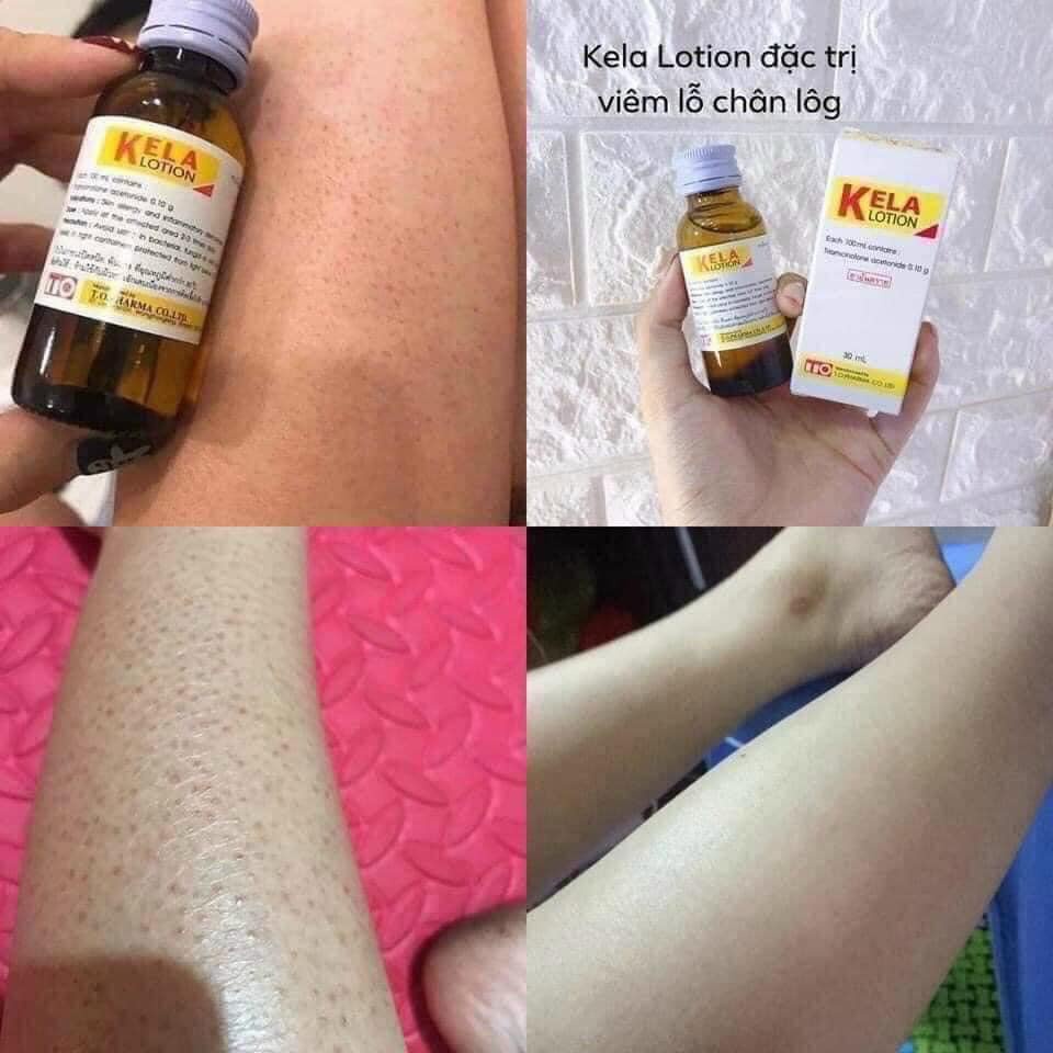 Lotion kela hỗ trợ nang lỗ chân lông thái laN