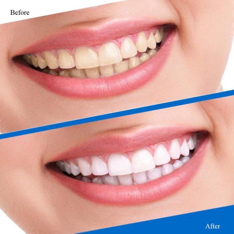 Miếng dán trắng răng 3D 5D White Teeth Whitening Strips Cao Cấp HUBEAUTY