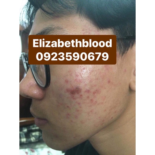 Gel bôi mụn cùng công thức với Differin Adapalene 0.1% dành cho da mụn ẩn mụn mủ viêm mụn đầu đen và da sần sùi | BigBuy360 - bigbuy360.vn