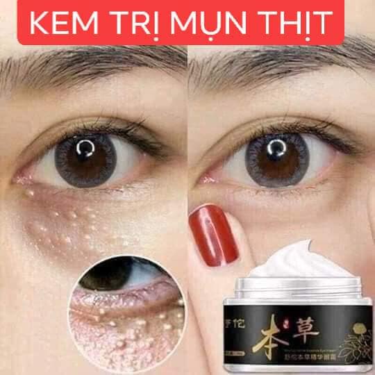 Cao tri mụn thitt đông y