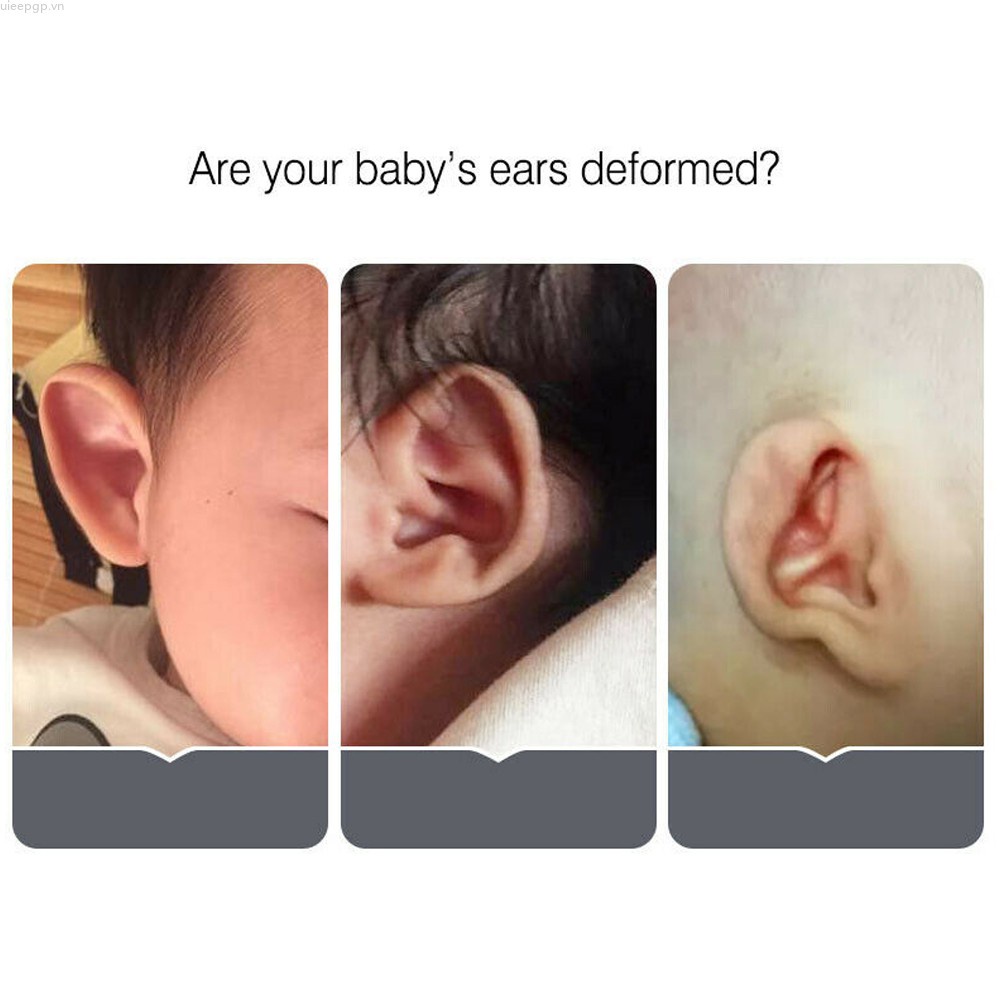 [Hàng mới về] Miếng dán bằng silicon chỉnh sửa dáng tai cho bé sơ sinh