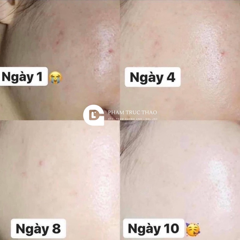 Kem A313 giảm mụn, mờ vết thâm và trẻ hoá da, 50g