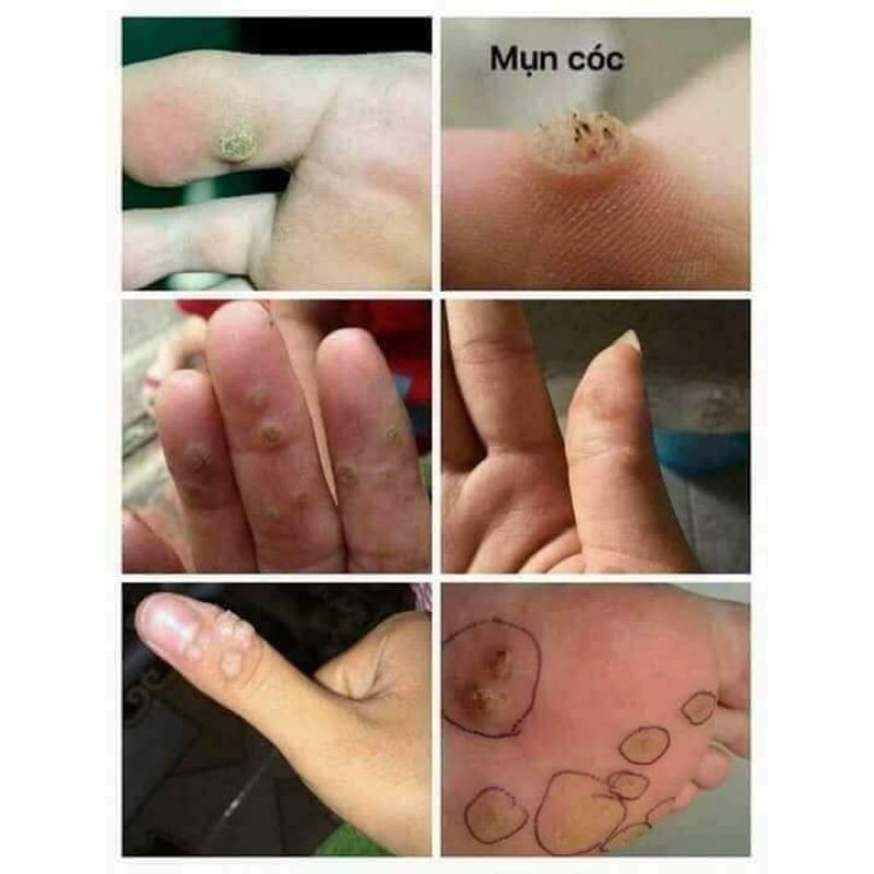 dung dịch diệt mụn cơm, mụn cóc, sạn cá | BigBuy360 - bigbuy360.vn