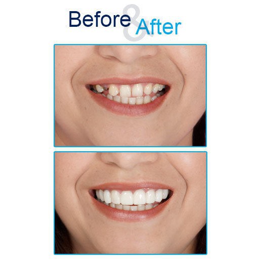 Răng giả Snap on smile loại tốt  O)