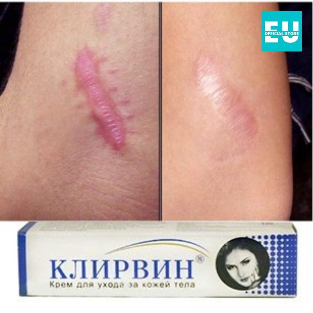 Kem Mờ Sẹo Thâm, Sẹo Lồi, Sẹo Lõm Klirvin Nga 25g