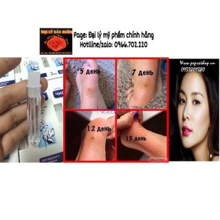 GEL DVELINIL TẨY NỐT RUỒI, MỤN CÓC, MỤN THỊT, SẸO LỒI NGA