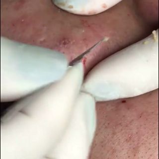 Dụng cụ nặn mụn Dao nặn mụn y tế