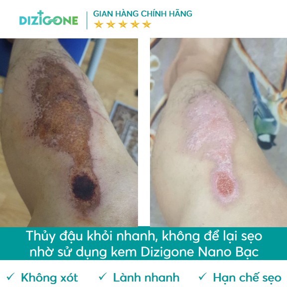 Kem Dizigone nano bạc - Kháng khuẩn, lành vết thương, tái tạo da, ngăn ngừa sẹo