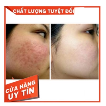 Kem Mụn Diếp Cá - Rau Má