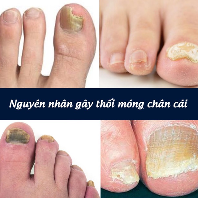 Kem trị thúi móng, nấm móng chân TINEACIDE Antifugal Cream 35g