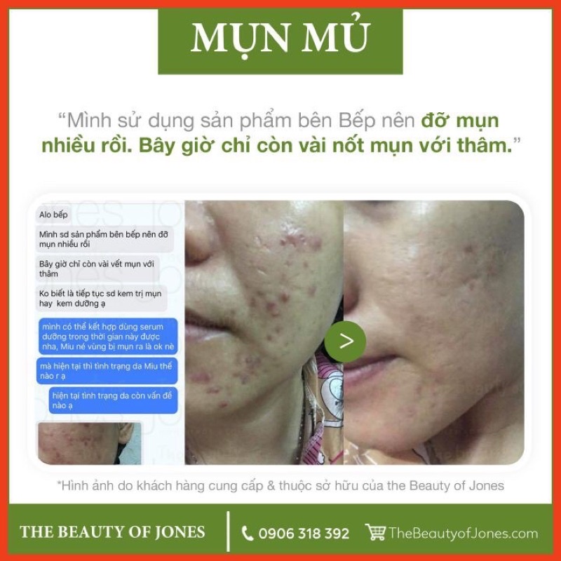 Sample Kem Chấm Mụn Tràm Trà 🌿 Cho Da Mụn Nhạy Cảm 👉 The Beauty Of Jones