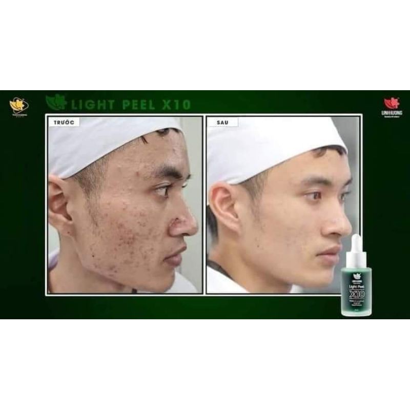 PEEL DA GIẢM NÁM, GIẢM MỤN, TRẺ HÓA DA[CHÍNH HÃNG] | BigBuy360 - bigbuy360.vn