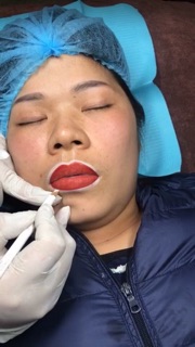 Chì định hình khuôn môi