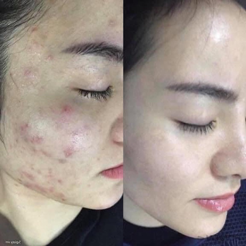 Huyết Thanh Sk10 1 Ống