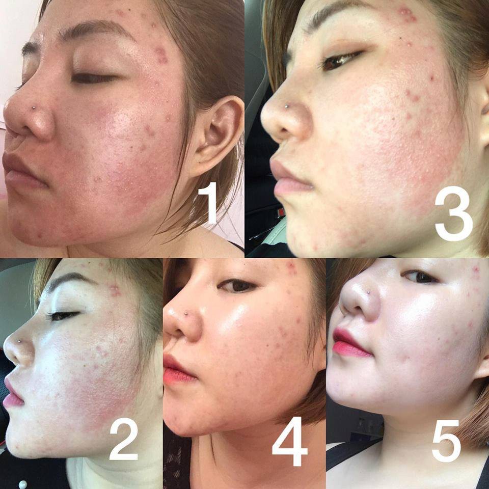 SERUM MỤN ẨN KOSXU